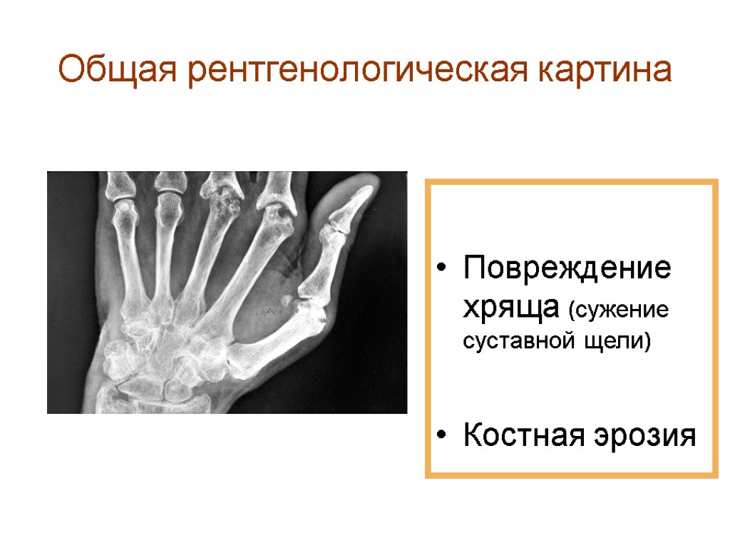 Общая рентгенологическая картина Повреждение хряща (сужение суставной щели) Костная эрозия